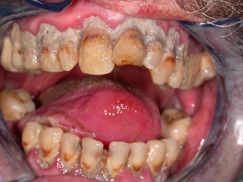 Zahnfleischbehandlung bei Dr. Gross und Schilling in Böblingen und  Ehningen